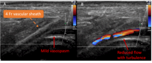 arterial access