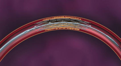 Wingspan stent