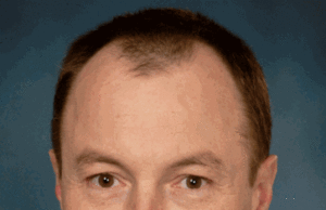 Predicting the removal of optionally retrievable caval filters