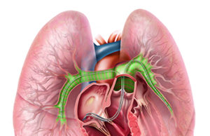 SEATTLE II trial shows Ekos system beneficial in treatment of acute pulmonary embolism