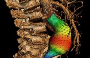Using virtual reality to improve endovascular aneurysm repair