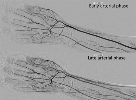 Post-intervention angiography