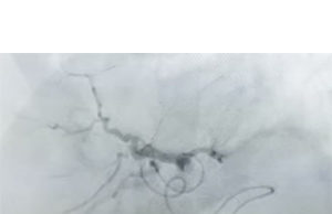 Mount Sinai Hospital first in US to offer radiopaque bead liver cancer treatment