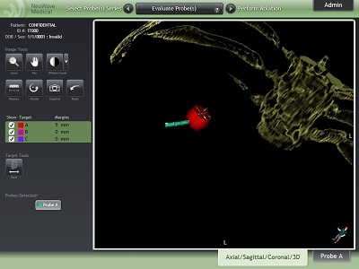 Neuwave_Ablation_tech_main_Main