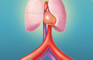 Arteriovenous anastomosis creation brings blood pressure down