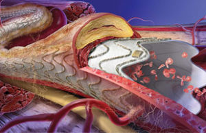 Gore receives CE mark for Gore Viabahn Endoprosthesis