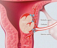 fibroid