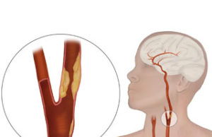 Silk Road Medical unveils data from the ROADSTER trial