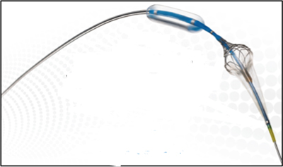 Contego Medical to commercialise Paladin carotid post-dilation balloon in Europe