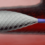 cosy-trial-shows-highly-reduced-radioembolization-procedure-time-and-radiation-dose