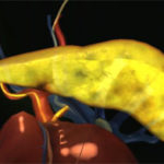 delcath-receives-regulatory-approval-for-the-generation-two-hepatic-chemosat-delivery-system-in-australia