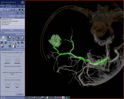 FDA clears FlightPlan for Liver imaging tool for liver embolization procedures