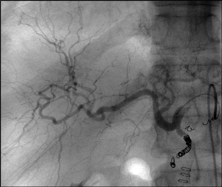 Interventional treatment with radioactive beads could help colon cancer patients live longer