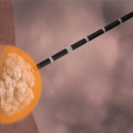 liver-tumour-ablation-more-predictable-with-emprint