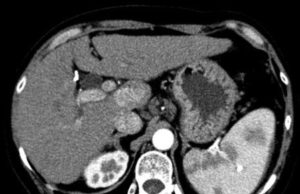 Lower rates of post-embolization syndrome and fatigue with smaller drug-eluting beads for hepatocellular carcinoma
