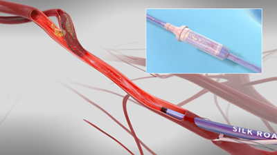 Silk Road Medical receives CE mark for next-generation Enroute transcarotid neuroprotection system