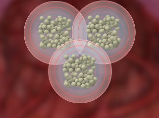 SIR-Spheres colorectal cancer treatment associated with significantly greater depth of tumour response