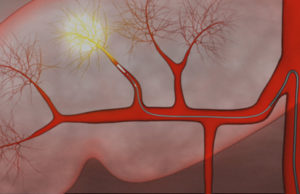 Surefire infusion system safe and effective for delivery of Y90