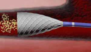 Surefire Medical completes patient enrolment in COSY trial