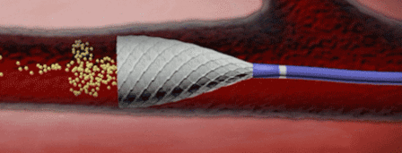 COSY trial shows highly reduced radioembolization procedure time and radiation dose