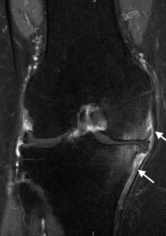 Figure 1: Coronal MRI with contrast (fat saturation). There is medial compartment osteoarthritis with joint space narrowing, subchondral oedema and increased contrast enhancement of hypertrophied medial synovium (arrows)