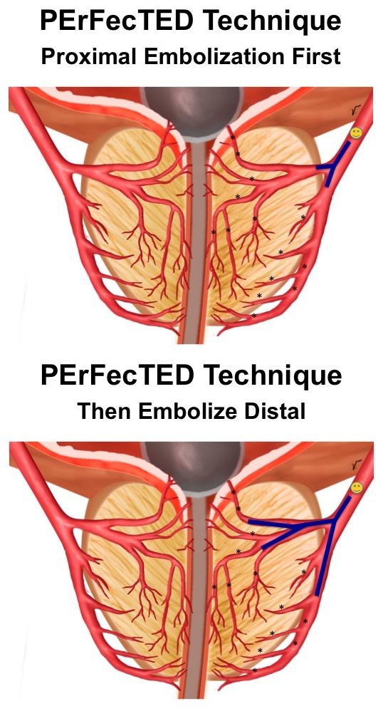 Figure 1: Illustrations representing the two steps of the PErFecTED Technique. (A) The microcatheter (yellow smiley face) should cross any collateral branch and be placed at the origin of the capsular and central gland branches. (B) After getting near stasis, the microcatheter should be advanced into the central and capsular branch for additional embolic agent injection.