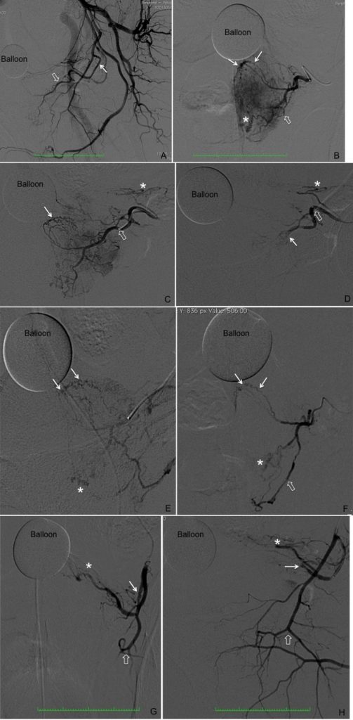 obturator artery angiogram