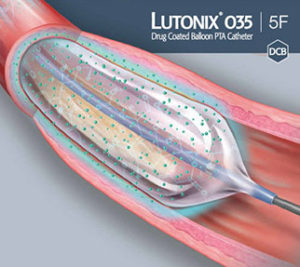 lutonix-035_new