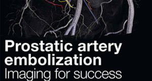 Prostatic artery embolisation