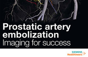 Prostatic artery embolisation