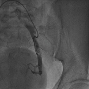 Selective catheterisation of the left hypogastric artery via contralateral femoral access.