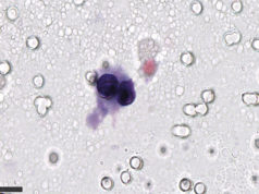 Cluster of two well-preserved tumour cells obtained by left hypogastric artery sampling