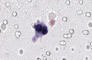 Cluster of two well-preserved tumour cells obtained by left hypogastric artery sampling