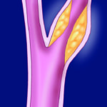 carotid artery disease_web