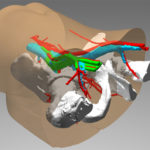 3d-print femoral access CT rendering