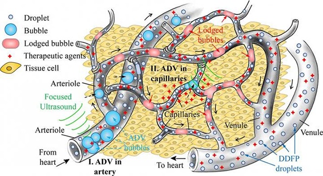 Image showing focused ultrasound making bubbles block blood vessels in gas embolotherapy