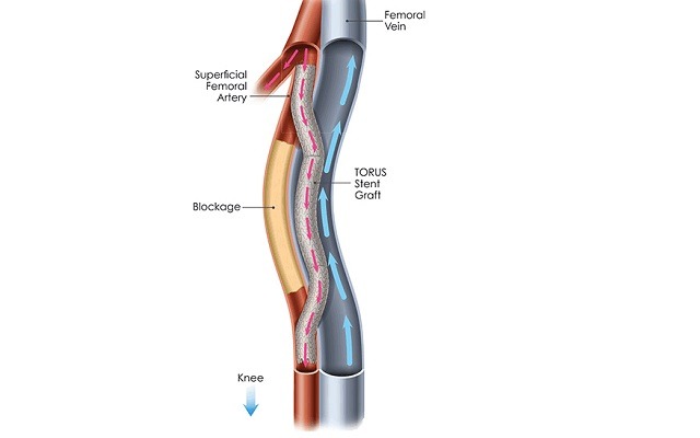 DETOUR I 12-month data show promising durability of bypass system