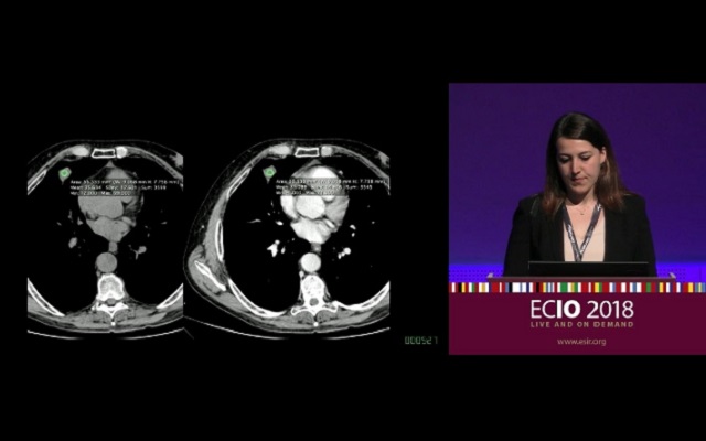CT-guided radiofrequency thermal ablation a safe alternative to surgery for HCC patients