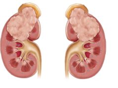 renal carcinoma