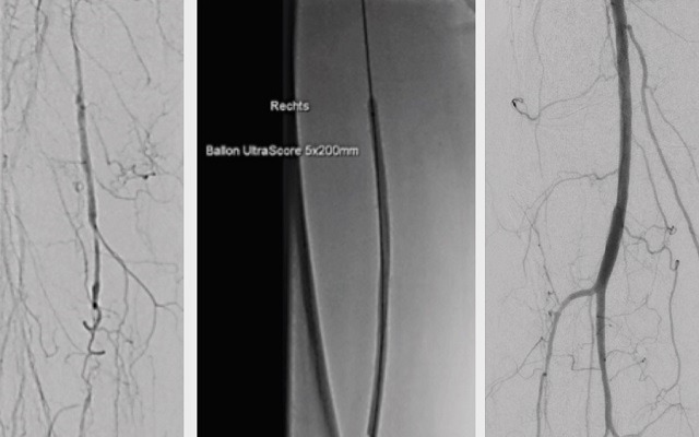 CASE REPORT: SFA-CTO Recanalization by using the novel 0.035″ ULTRASCORE Focused Force PTA Balloon and DCB