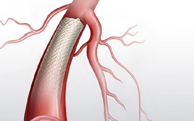 Covered stent provides greater patency than angioplasty alone in AV fistulae