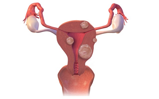 Same day release for uterine fibroid embolization patients at Royal Stoke University Hospital