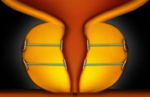 12-month data show UroLift system a good treatment option for men with BPH UroLift