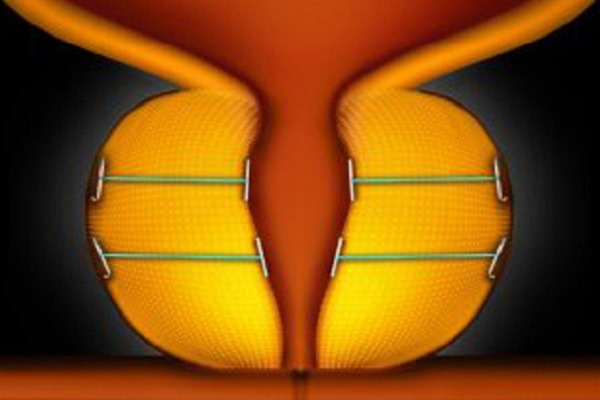 12-month data show UroLift system a good treatment option for men with BPH