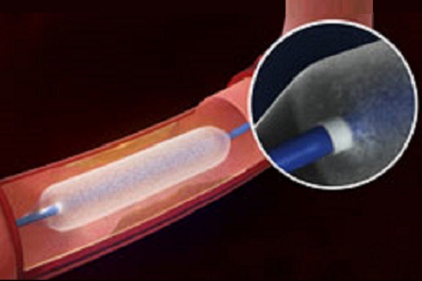 BD’s Lutonix 018 DCB approved by FDA to treat SFA disease