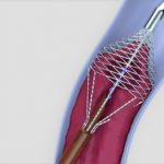 Vetex Thrombectomy Catheter
