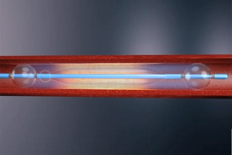 Novel catheter delivering liquid paclitaxel safely and effectively prevents restenosis in below-the-knee lesions