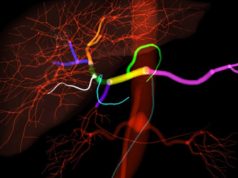 Mentice donates IR simulators to Rad-Aid mentice