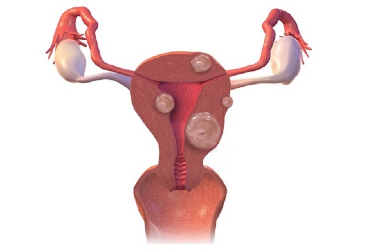 Uterine fibroid embolization safer and as effective as surgical treatment