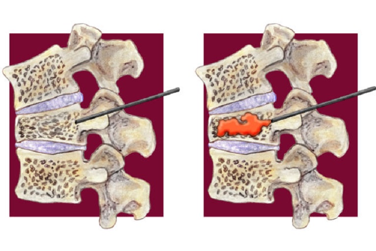 “No further trials of vertebroplasty should be performed”, report concludes